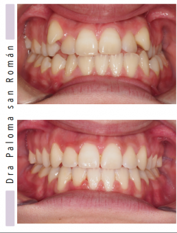 Ortodoncia. Tratamiento Dental Attitude de la dra Paloma San Román