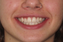 Ortodoncia. Tratamiento Dental Attitude de la dra Paloma San Román