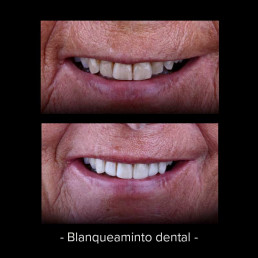 Antes y despues. Blanqueamiento dental. Tratamientos dental Attitude
